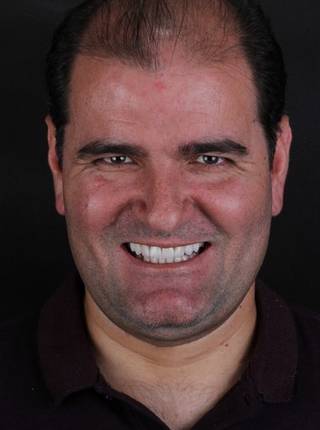 LENTES DE CONTATO DENTAIS EM PORCELANA de G.A.S.