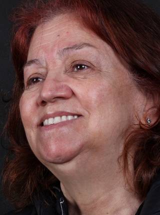 PRÓTESE TOTAL FIXA EM IMPLANTES de E.M.S.