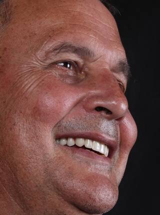 PRÓTESE TOTAL FIXA EM IMPLANTES de M.A.E.