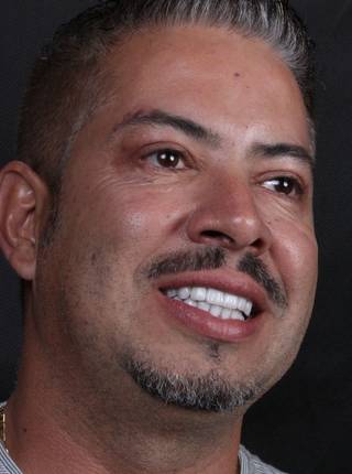 LENTES DE CONTATO DENTAIS EM PORCELANA de L.J.P.