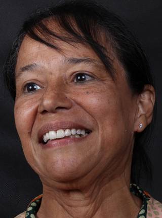 LENTES DE CONTATO DENTAIS EM PORCELANA de A.C.F.