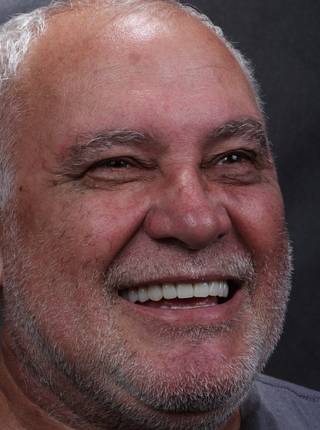 PRÓTESE TOTAL FIXA EM IMPLANTES de E.D.A.F