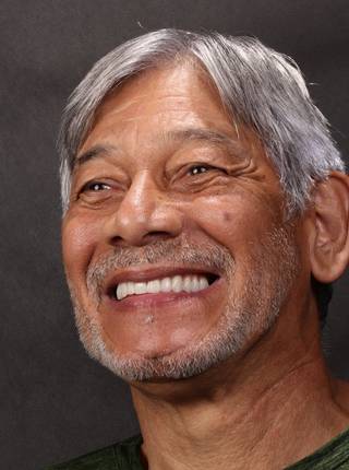 PRÓTESE TOTAL FIXA EM IMPLANTES de W.R.D.O.