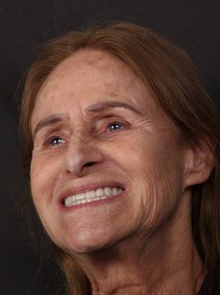 PRÓTESE TOTAL FIXA EM IMPLANTES de T.A.C.