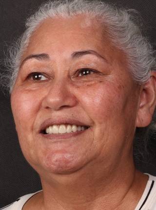 PRÓTESE TOTAL FIXA EM IMPLANTES de M.B.D.M.C.