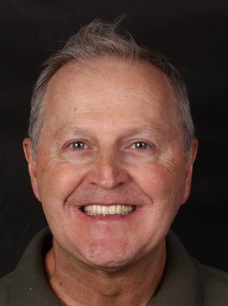 PRÓTESE TOTAL FIXA EM IMPLANTES de M.S.J.