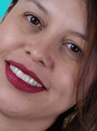 LENTES DE CONTATO DENTAIS EM PORCELANA de Gislaine Rodrigues Moreno