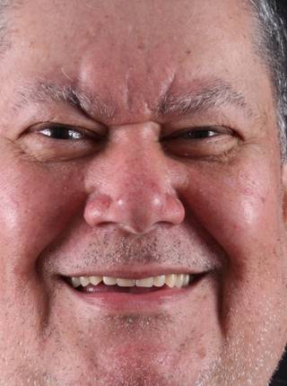 PRÓTESE TOTAL FIXA EM IMPLANTES de W.C.F.