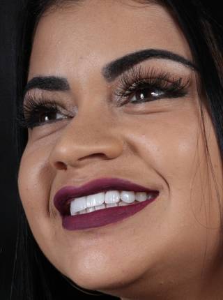 LENTES DE CONTATO DENTAIS EM PORCELANA de P.M.F.V.