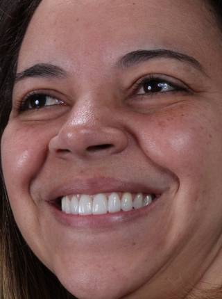 LENTES DE CONTATO DENTAIS EM PORCELANA de S.G.A.