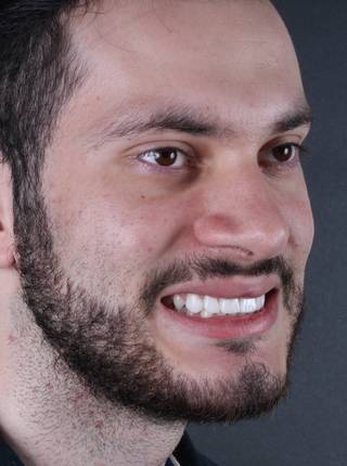 LENTES DE CONTATO DENTAIS EM PORCELANA de R.S.R.