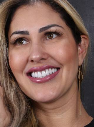 LENTES DE CONTATO DENTAIS EM PORCELANA de J.L.B.