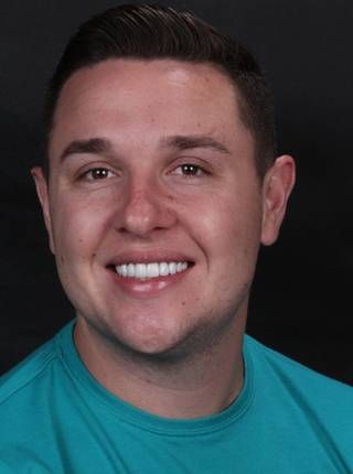 LENTES DE CONTATO DENTAIS EM PORCELANA de M.O.