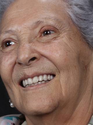 PRÓTESE TOTAL FIXA EM IMPLANTES de I.E.P.