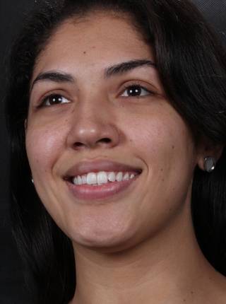 CLAREAMENTO DENTAL de E.N.S.B.