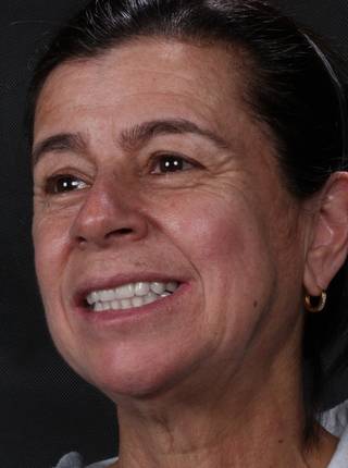 PRÓTESE TOTAL FIXA EM IMPLANTES de L.G.B.