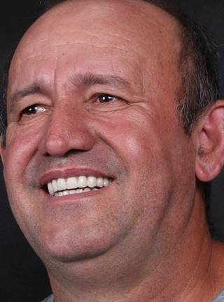 PRÓTESE TOTAL FIXA EM IMPLANTES de E.P.C.