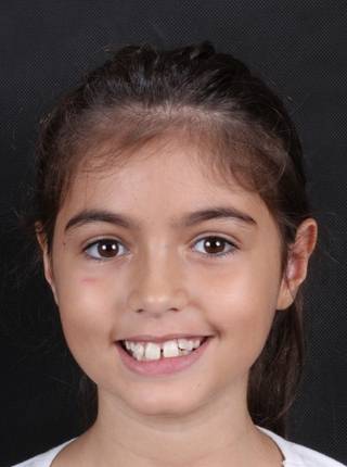 INVISALIGN de G.C.T.