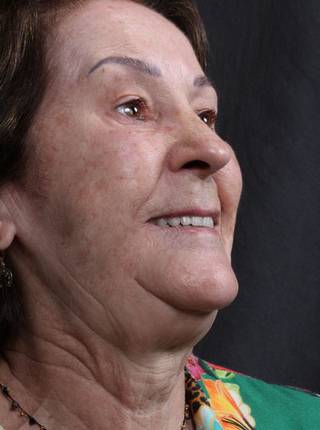 PRÓTESE TOTAL FIXA EM IMPLANTES de M.S.R.S.