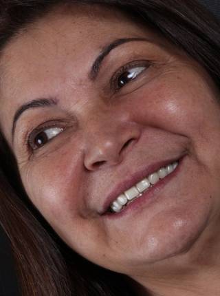 PRÓTESE TOTAL FIXA EM IMPLANTES de P.S.L.