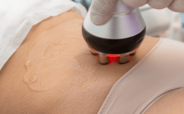 Radiofrequência no tratamento da diástase abdominal