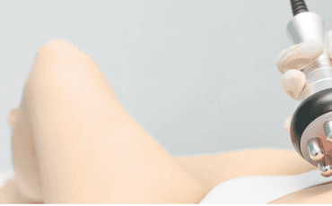 Radiofrequência Íntima: tecnologia a favor da saúde e bem-estar feminino