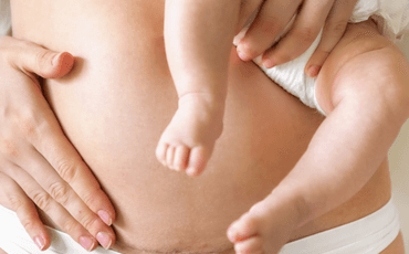 Laserterapia para cesárea 