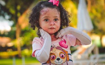 Quando os filhos adoecem - Epidermólise Bolhosa