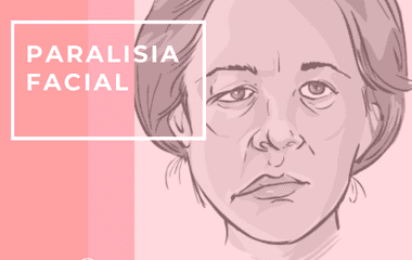 PARALISIA FACIAL PERIFÉRICA OU PARALISIA DE BELL