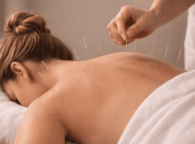 Tratamentos de Acupuntura