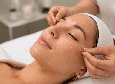 Tratamentos de Acupuntura estética
