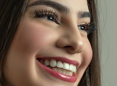 Facetas em resina composta de Carol