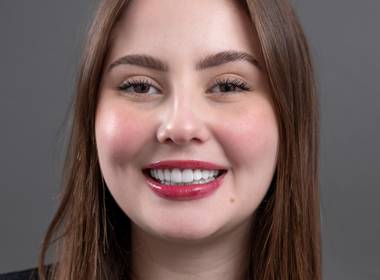 Facetas em resina composta de Flávia