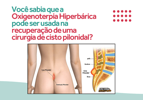 Você sabia que a Oxigenoterapia Hiperbárica pode ser usada na recuperação de uma cirurgia de cisto pilonidal?