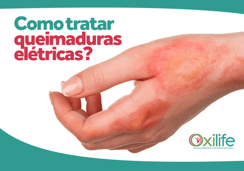 Como tratar queimaduras elétricas?