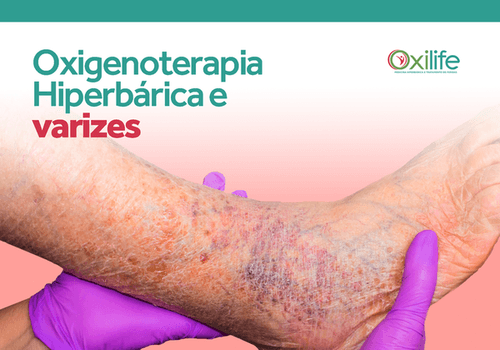 Oxigenoterapia Hiperbárica e varizes