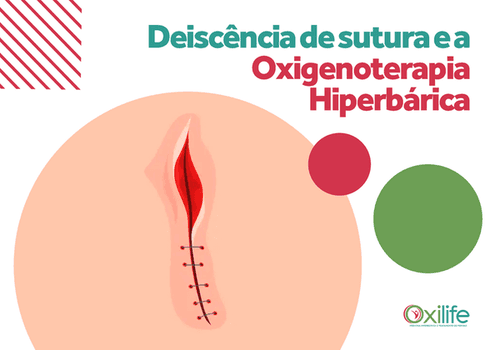 Deiscência de sutura e a Oxigenoterapia Hiperbárica