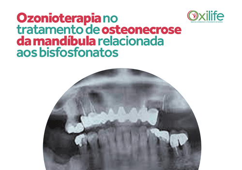 Ozonioterapia no tratamento de osteonecrose da mandíbula relacionada aos bisfosfonatos