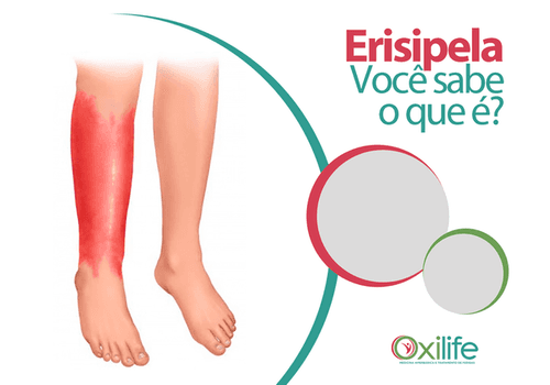 Erisipela. Você sabe o que é?