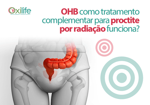 OHB como tratamento complementar para proctite por radiação funciona?