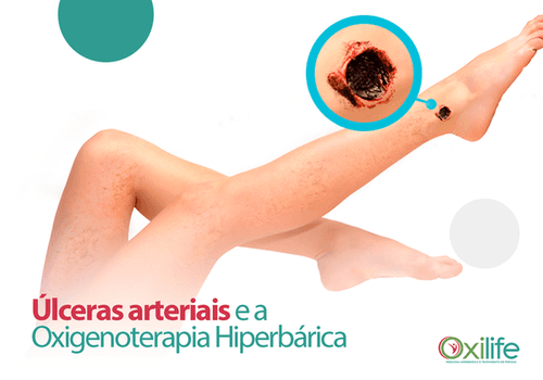 Úlceras arteriais e a Oxigenoterapia Hiperbárica