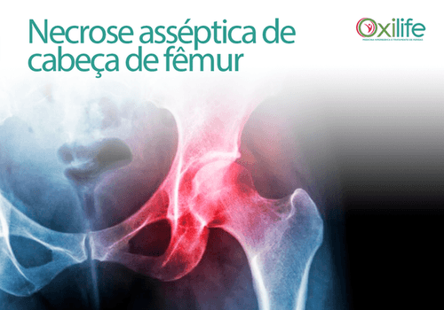 Necrose asséptica de cabeça de fêmur