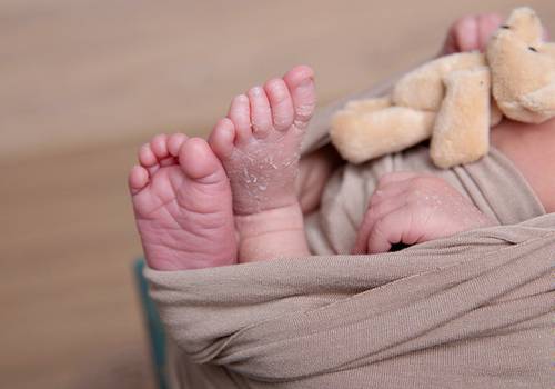 O Que Você Sabe Sobre a Descamação nas Mãos e Pés do Bebê?