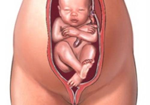 PARTO PÉLVICO VAGINAL