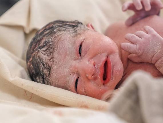 Parto Cesárea de Nascimento Alice