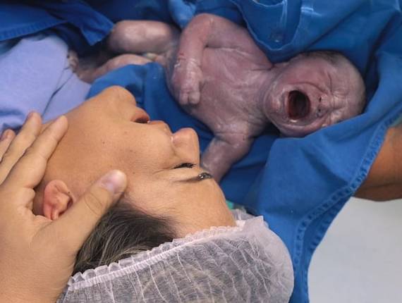 Parto Cesárea de Nascimento João Valentim