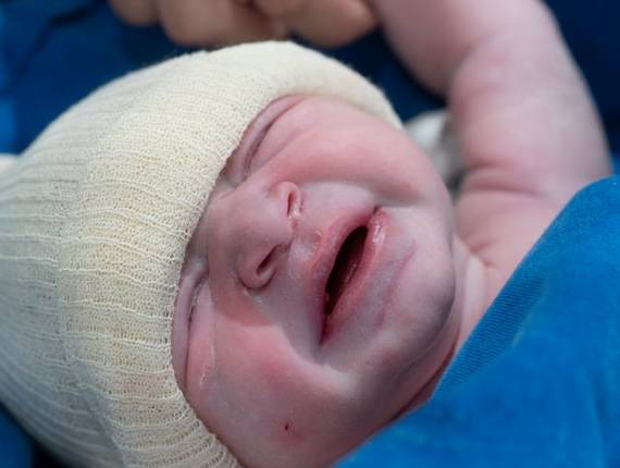 Parto Cesárea de Nascimento Murilo