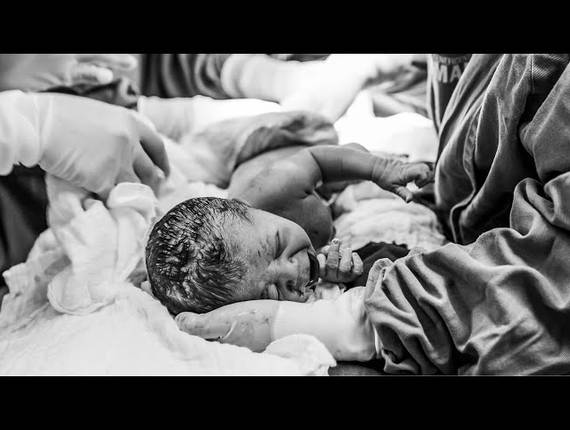 Parto Cesárea de Nascimento Henri 