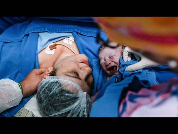 Parto Cesárea de Nascimento Íris