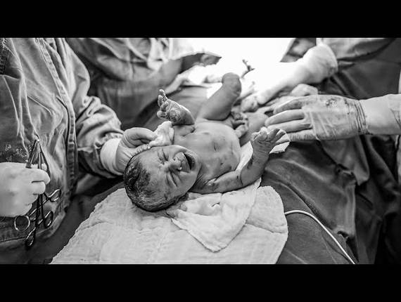 Parto Cesárea de Nascimento Théo